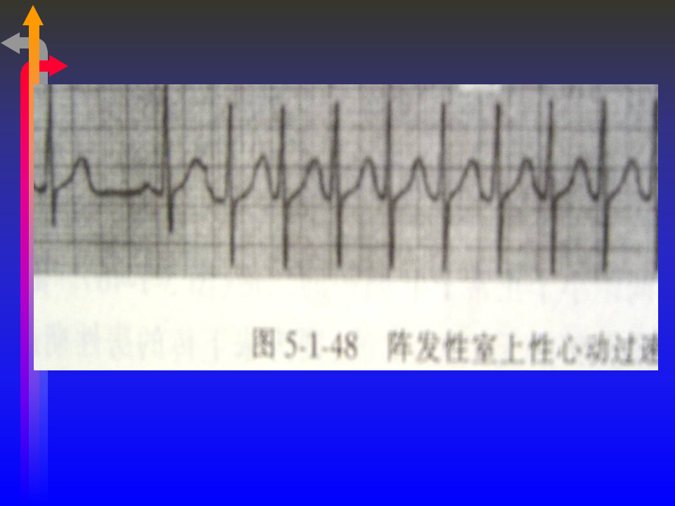 心电图－第五次课（心律失常二）.ppt 第4页