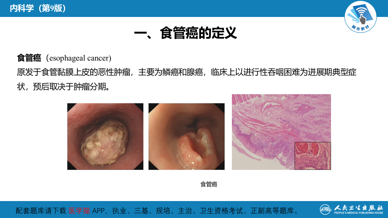 第三章  食管癌.pptx 第4页