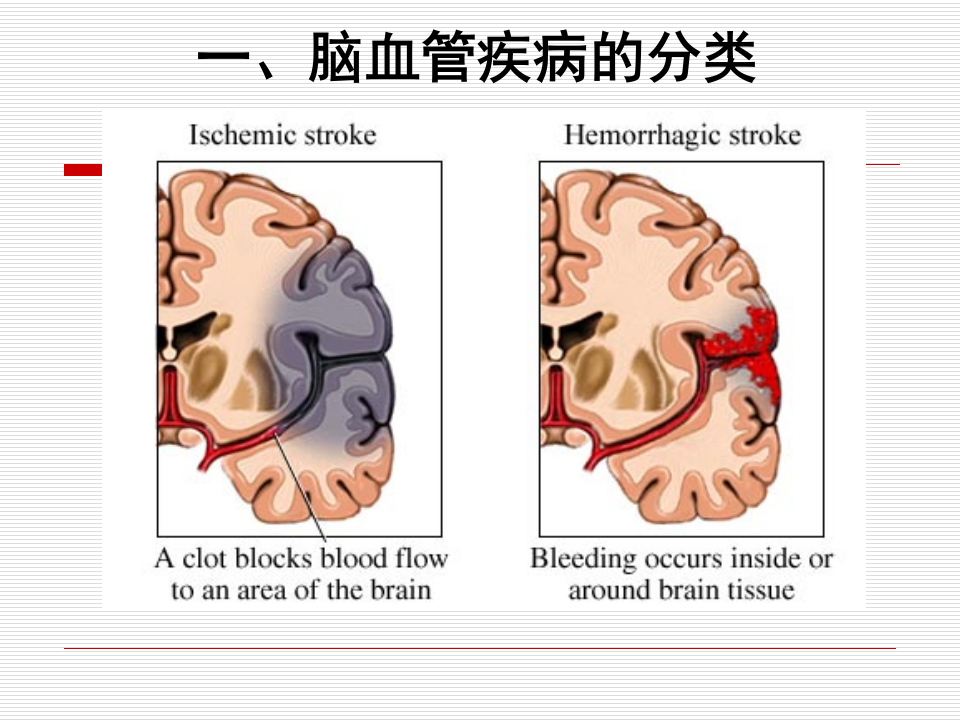 脑血管疾病-中日联谊医院.ppt 第5页