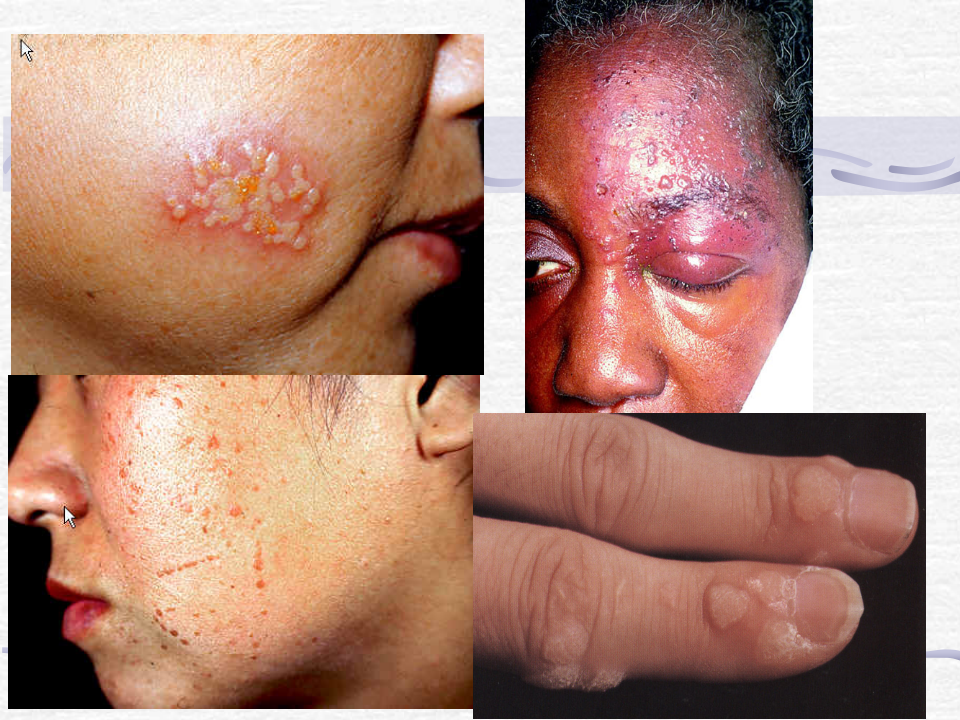 3)春季放射口腔病毒、细菌性皮肤病-新.ppt 第3页