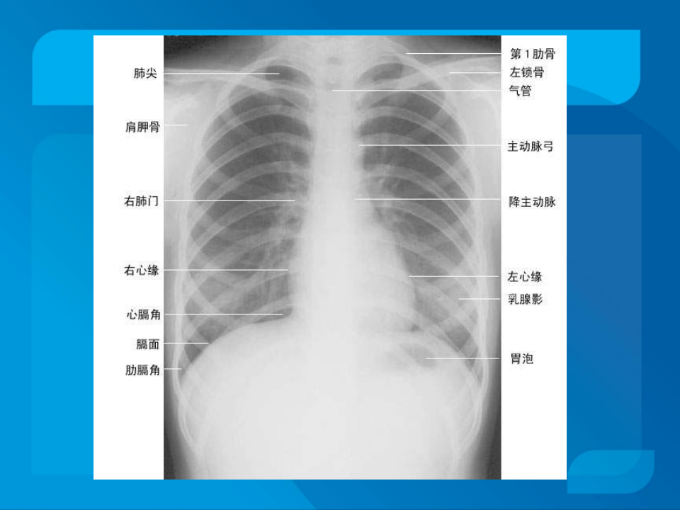 传染科-脓胸.ppt 第3页