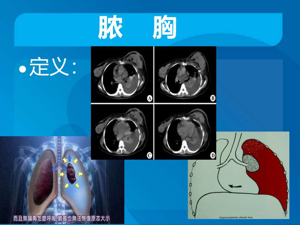 传染科-脓胸.ppt 第4页