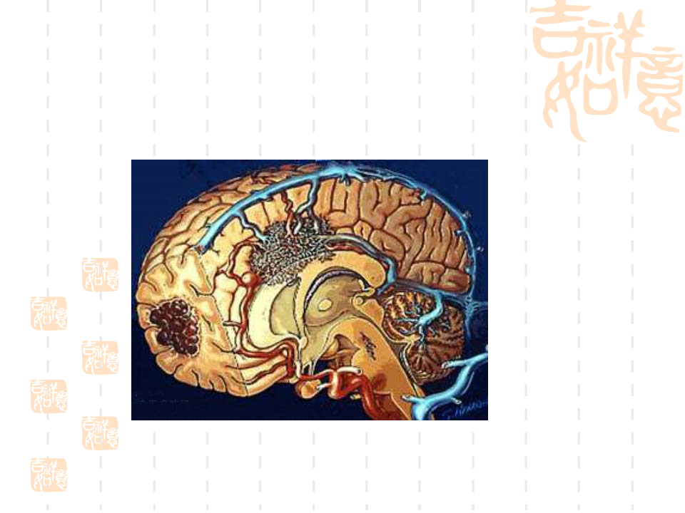 神经内科脑血栓.ppt 第2页