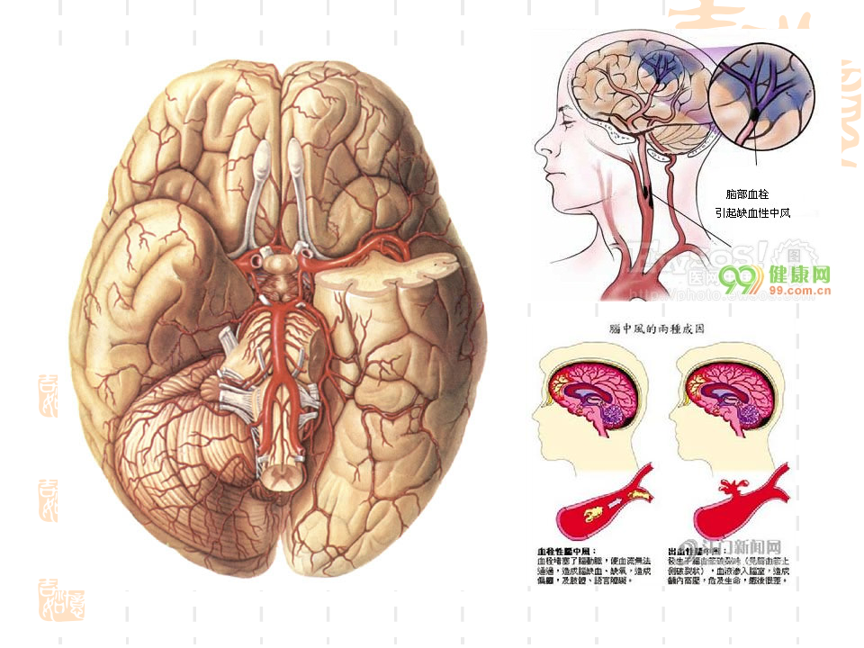 神经内科脑血栓.ppt 第4页