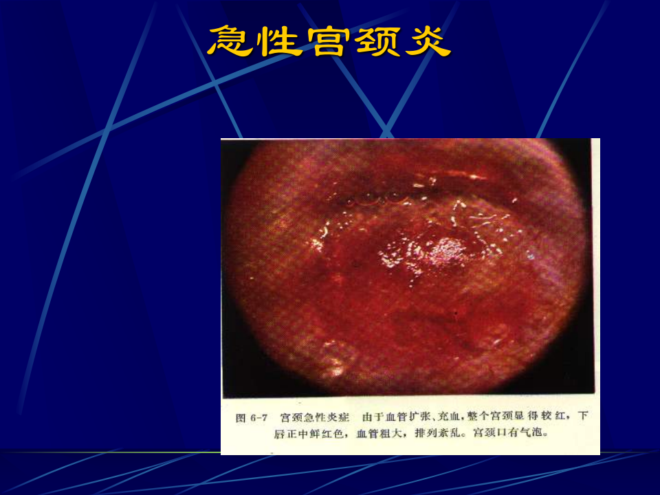 妇产科-盆腔炎宫颈炎.ppt 第4页