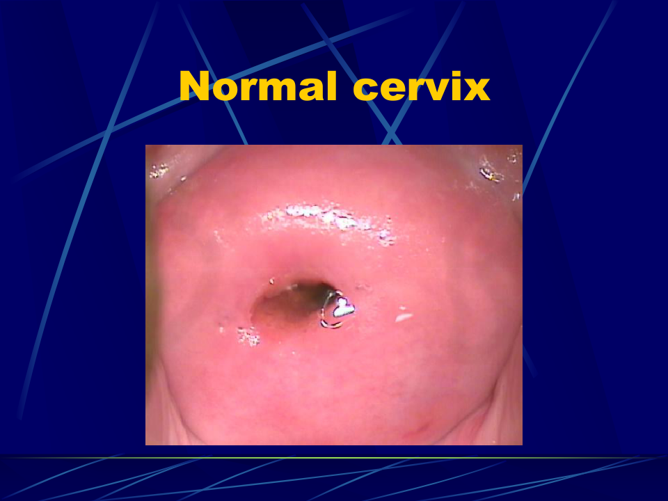 妇产科-盆腔炎宫颈炎.ppt 第5页