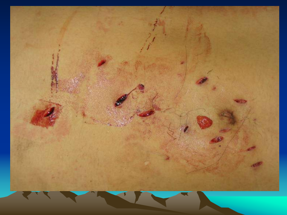 68内科-腹部闭合性损伤.ppt 第5页