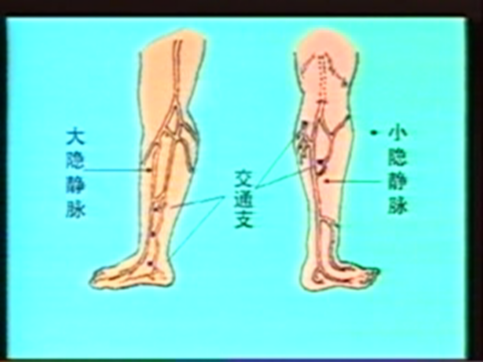 127下肢静脉曲张病人的护理.ppt 第4页