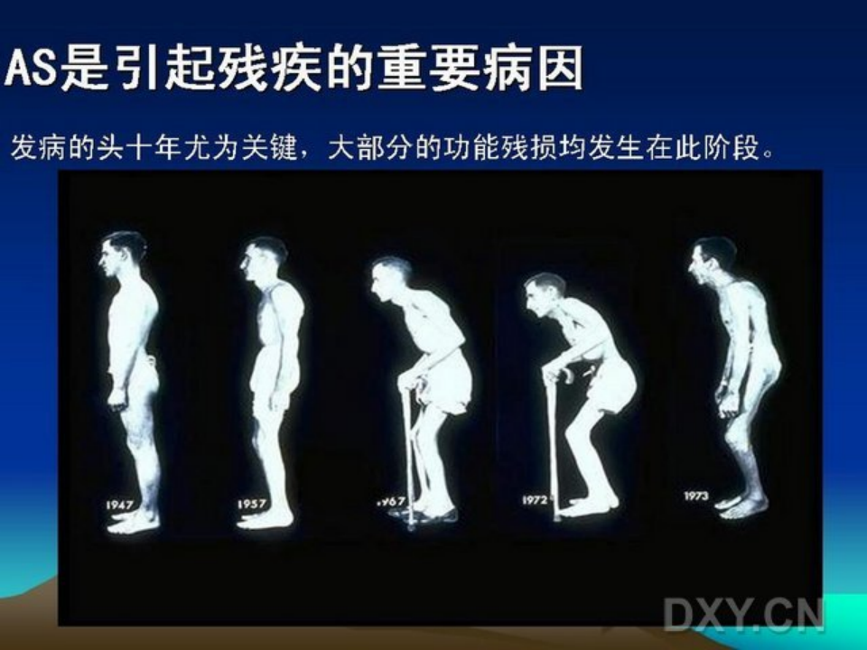 骨科-强直性脊柱炎.ppt 第5页