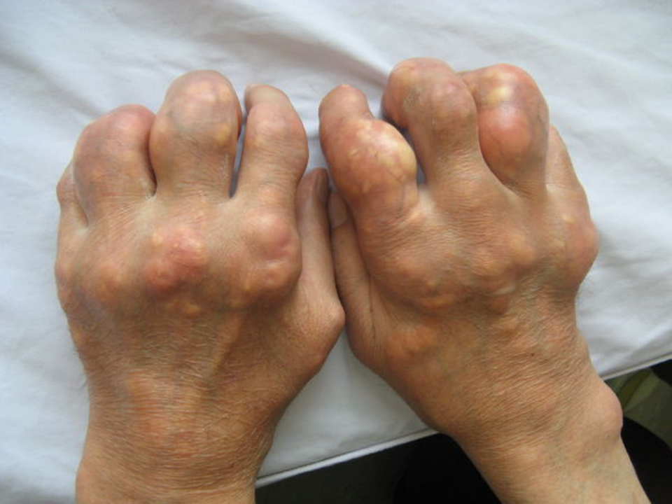 风湿免疫科-痛风.ppt 第5页