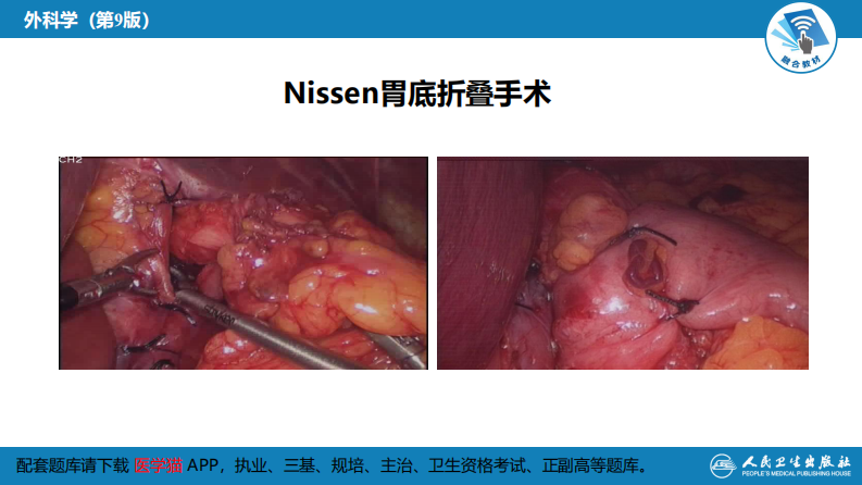 第二十七章 食管疾病 腹腔镜胃底折叠术技术要领.pdf 第5页