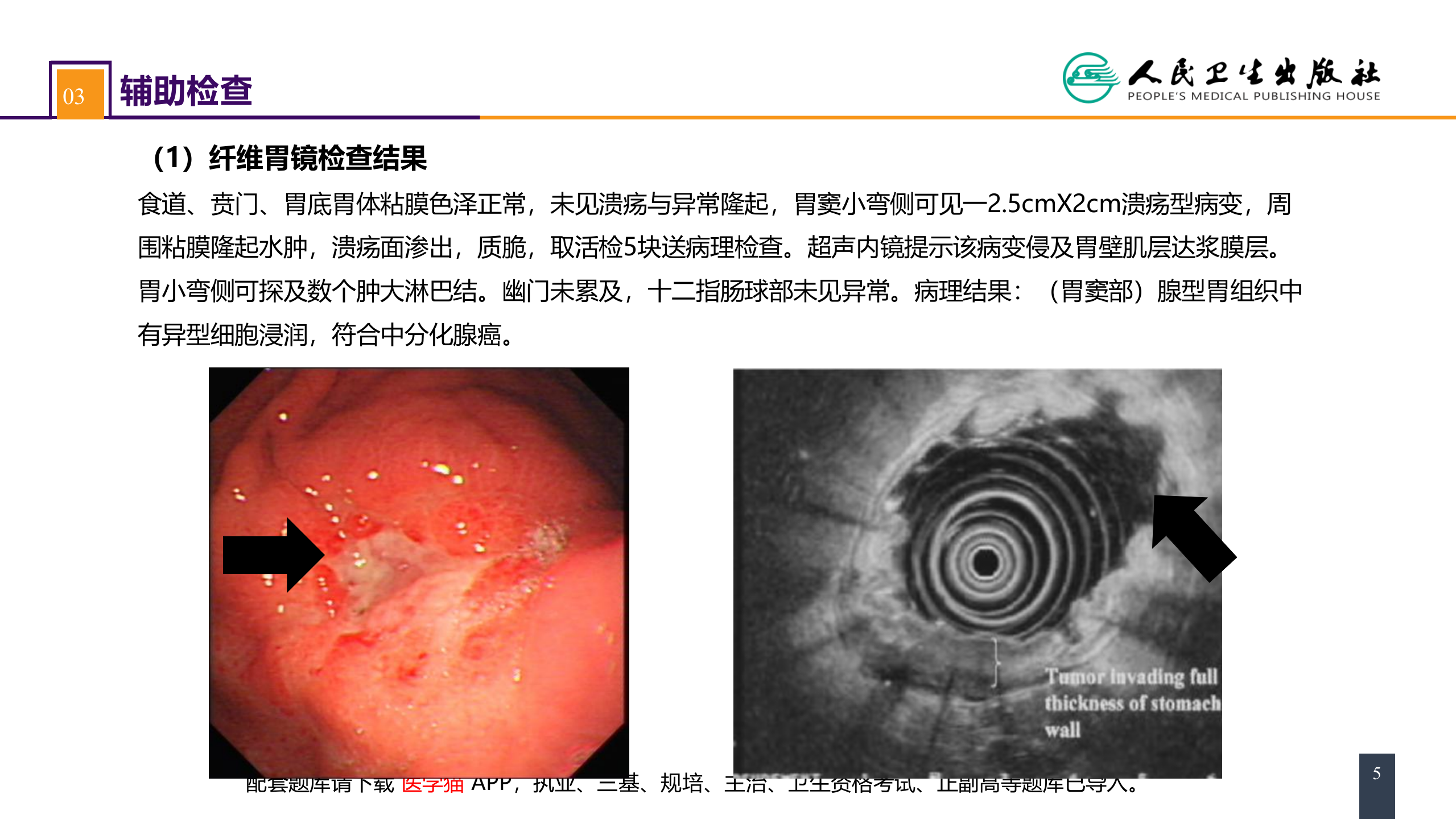 第三十四章 胃十二指肠疾病 案例分析-胃癌.pptx 第5页