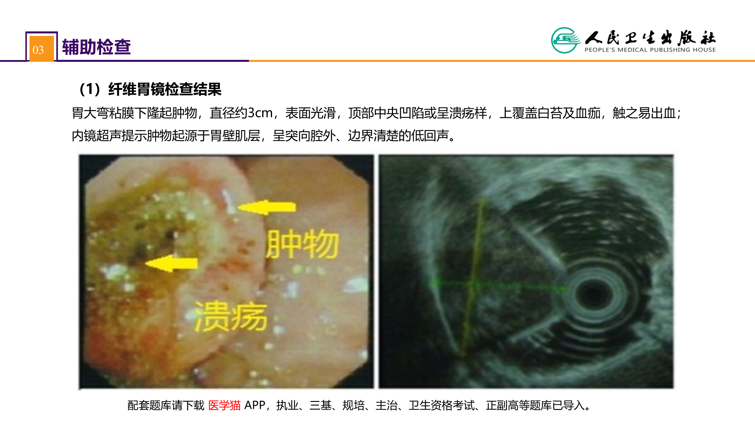 第三十四章 胃十二指肠疾病 案例分析-胃间质瘤.pptx 第5页