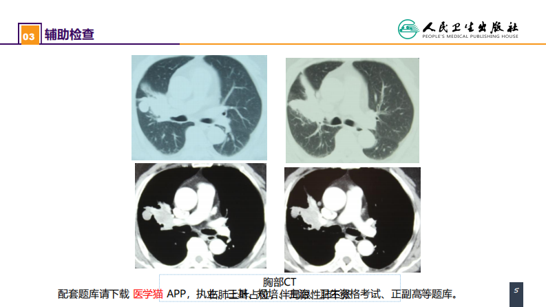 第二十六章 肺部疾病 案例分析-原发性肺癌.pdf 第5页