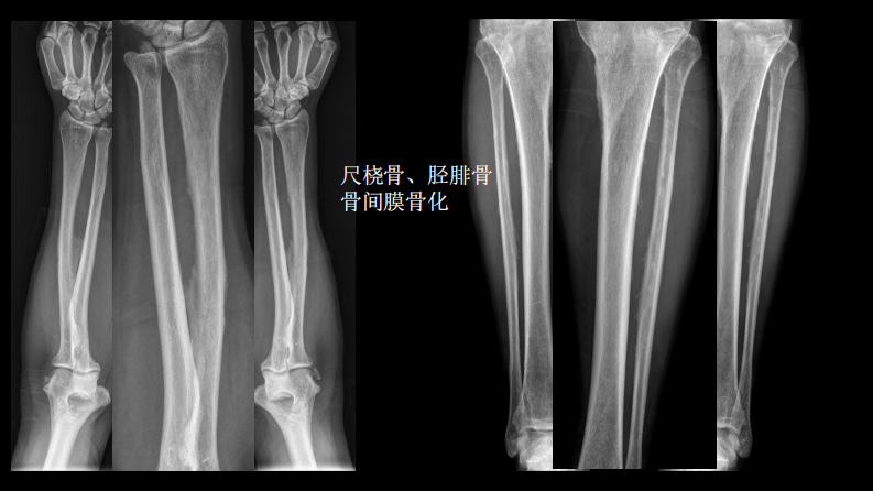 氟骨症的X线CT及MR影像及解读.pdf 第5页