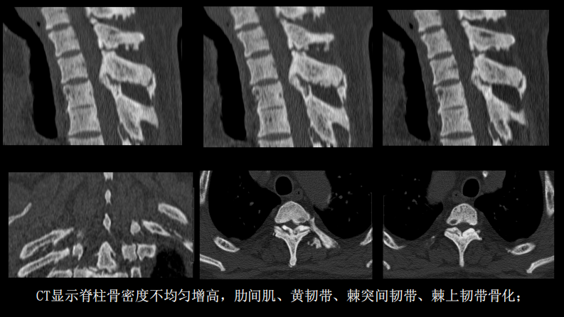 氟骨症的X线CT及MR影像及解读.pdf 第4页