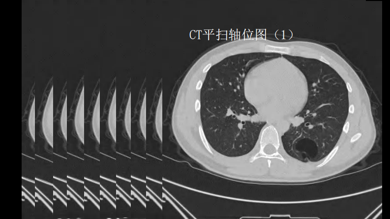 这样的肺隔离症：影像共享.pdf 第5页
