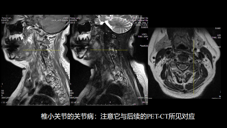 椎体局灶性病变：综合影像学评判.pdf 第5页