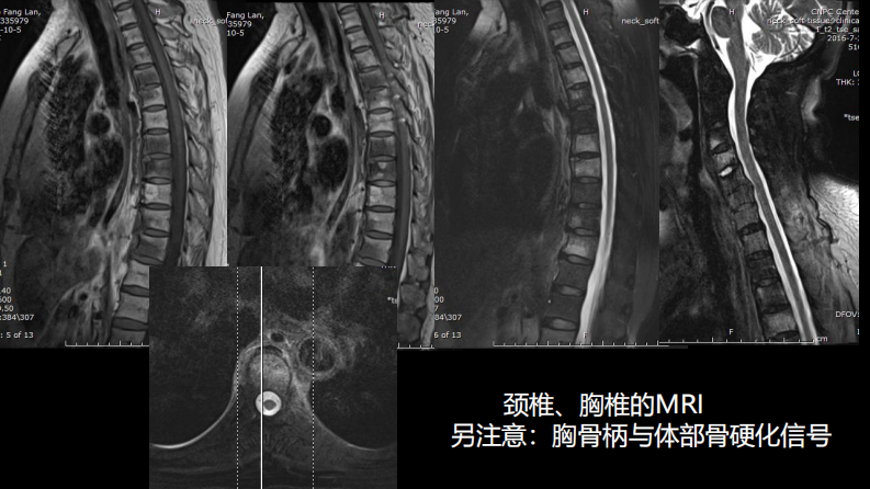 椎体局灶性病变：综合影像学评判.pdf 第4页