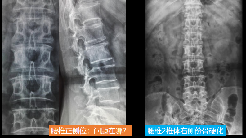 一例椎体的局灶病变影像表现分析暨影像诊断扩展.pdf 第4页