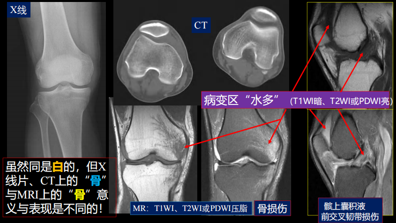 膝关节损伤：MR图像解读.pdf 第4页