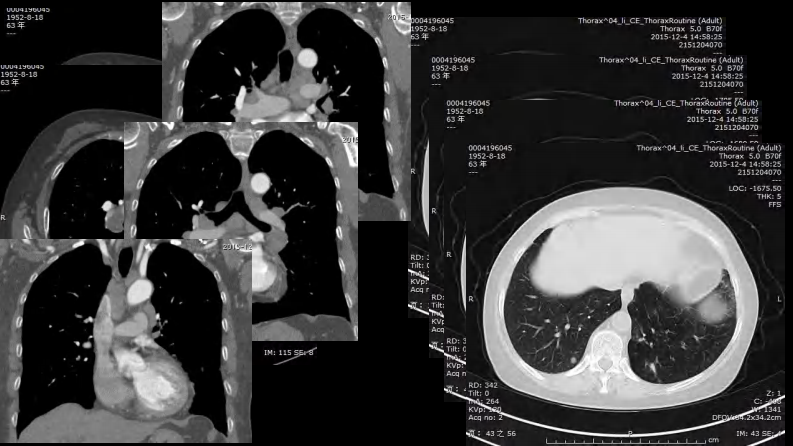 胸部结节病综合影像学交流.pdf 第5页