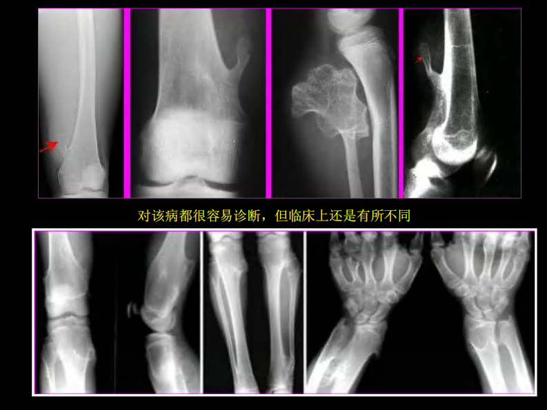 骨肿瘤影像学诊断.pdf 第5页