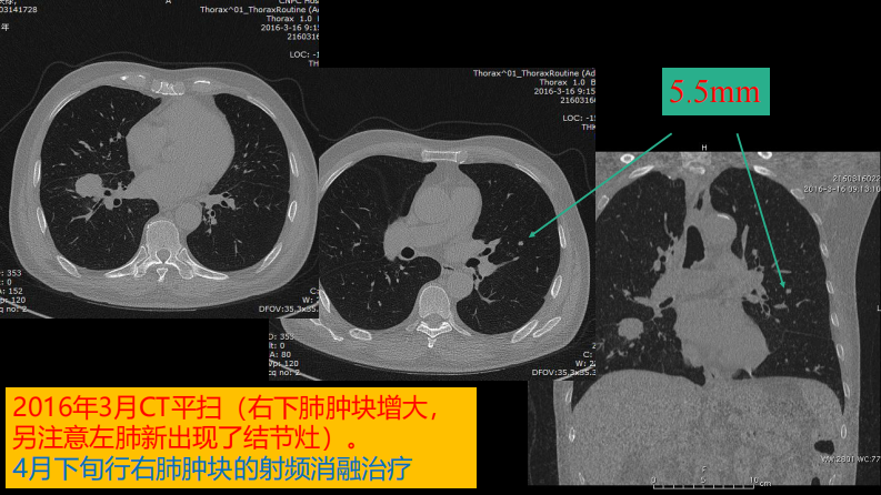 这例肺部病灶的比较影像学：价值评判.pdf 第5页