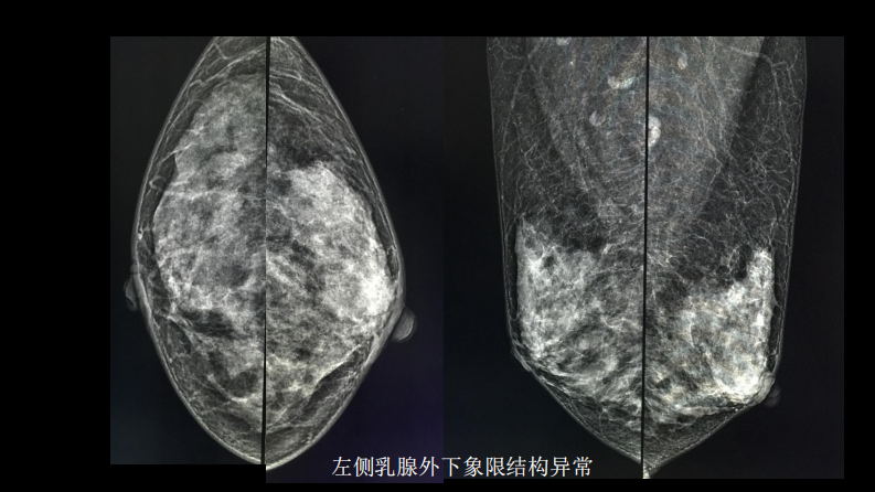 乳腺囊性肿块MRI：鉴别不困难.pdf 第4页