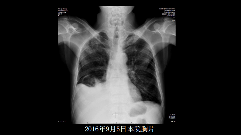 没有见过的弥漫性的骨质破坏.pdf 第4页