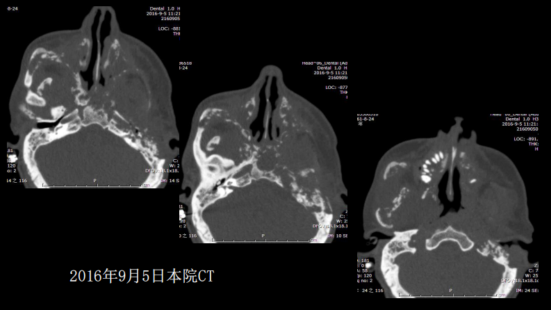 没有见过的弥漫性的骨质破坏.pdf 第5页