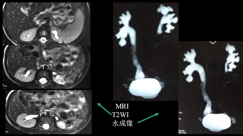 影像科容易忽略的病：膀胱输尿管反流.pdf 第4页