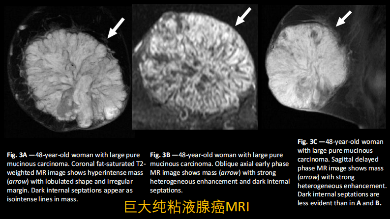 乳腺粘液腺癌MR与病理特点.pdf 第4页