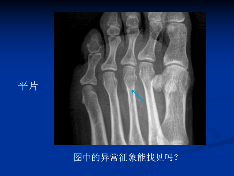影像学病例读片-应力性骨折.pdf 第4页