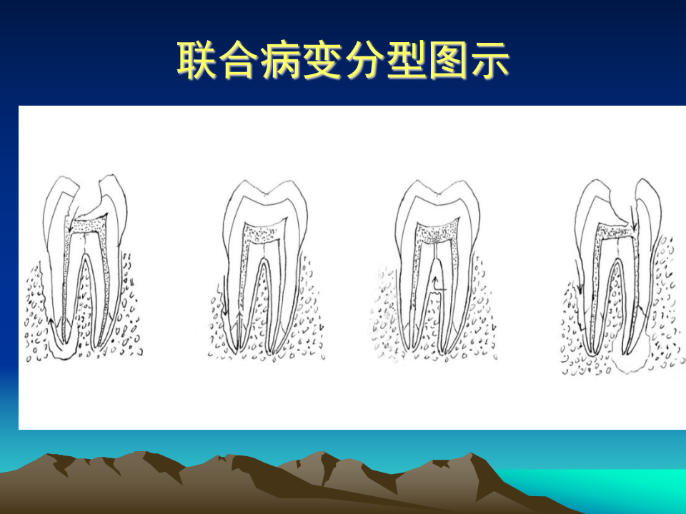 牙周病1.ppt 第3页