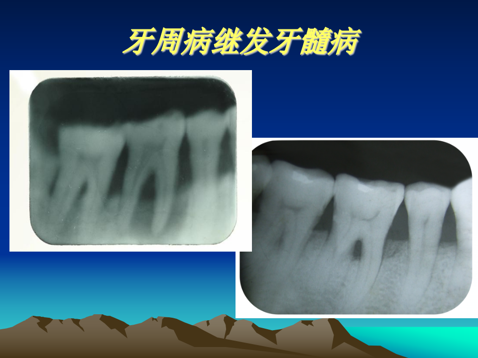 牙周病1.ppt 第5页