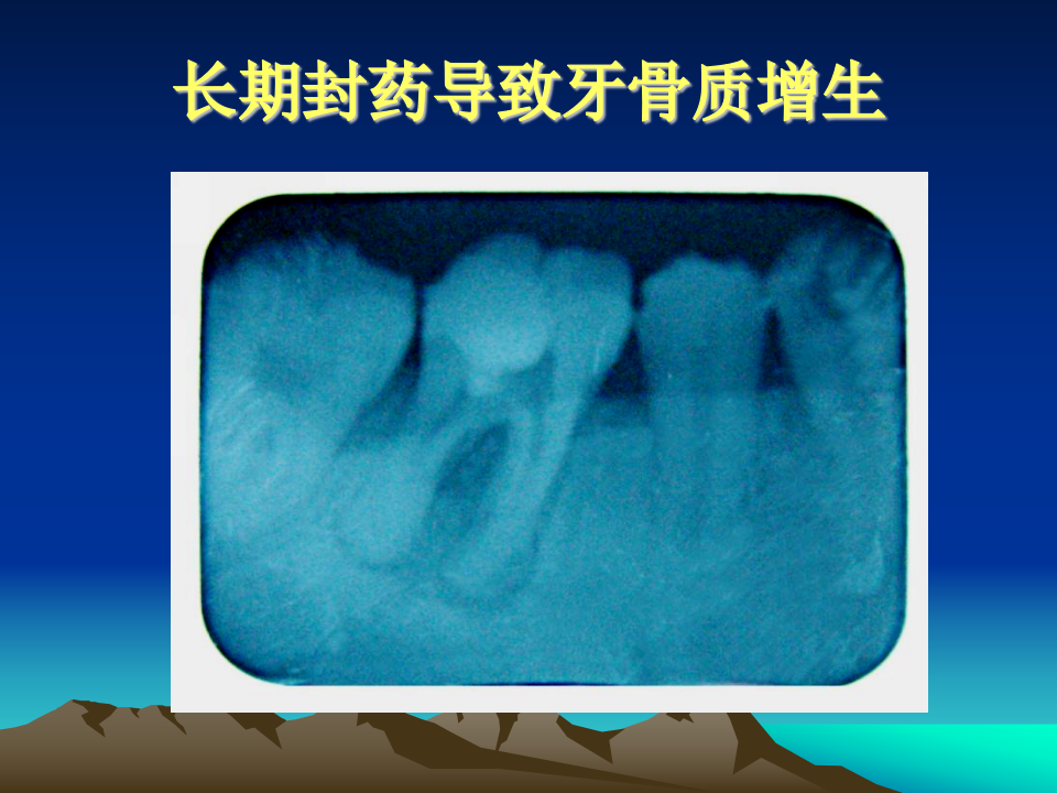 牙周病2.ppt 第5页