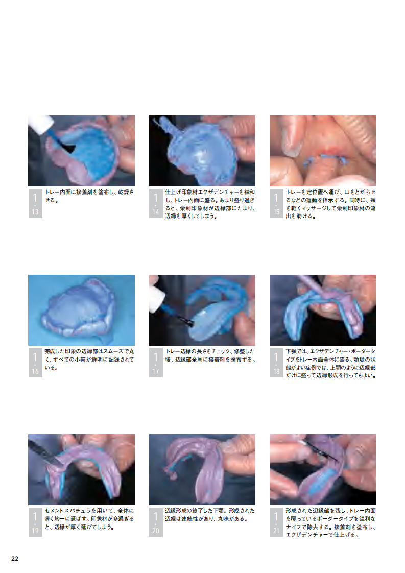 采用硅橡胶印模材料的简便的无牙颌功能印模.pdf 第3页