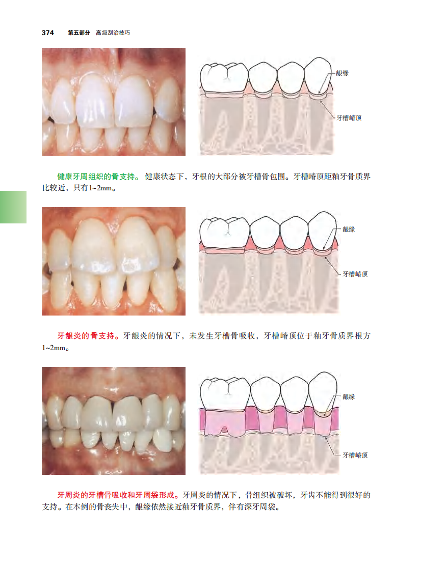 第五部分 高级刮治技巧.pdf 第4页