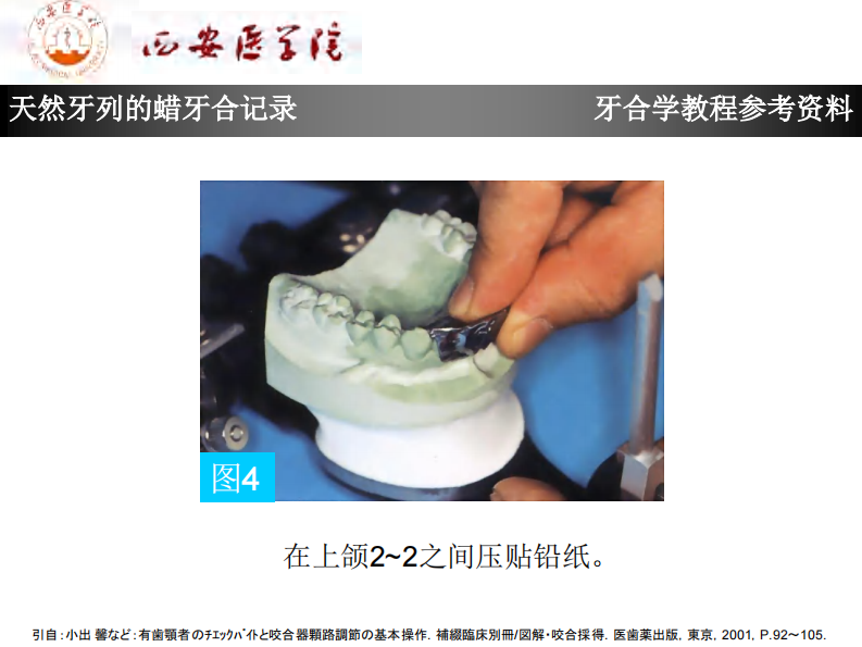 天然牙列的蜡牙合记录.pdf 第5页