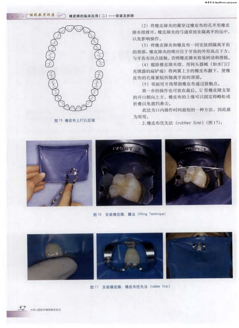 橡皮障的临床应用（二）——安装及拆除.pdf 第2页