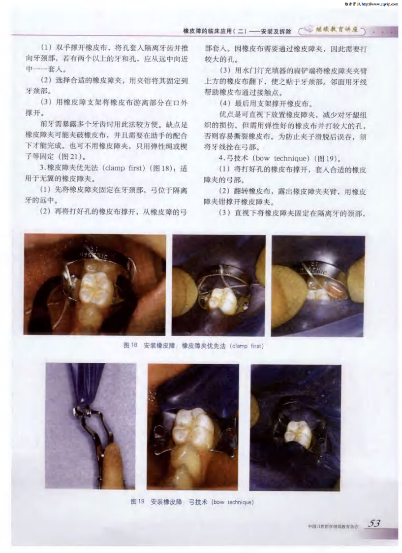 橡皮障的临床应用（二）——安装及拆除.pdf 第3页