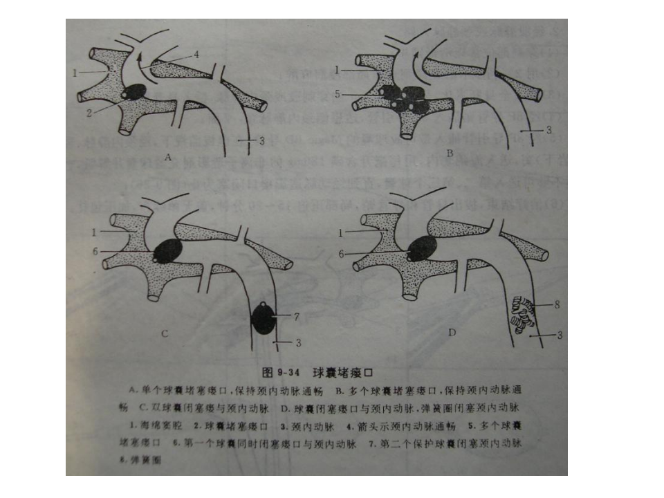 04-05 介入性神经放射学.ppt 第5页