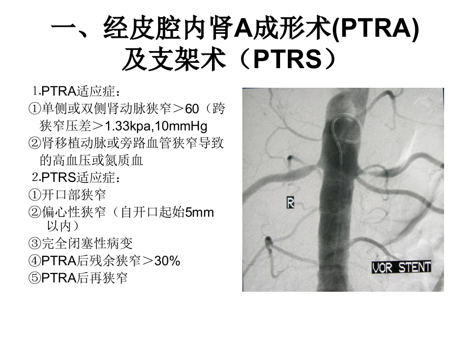 04-05 泌尿生殖系统介入放射学.ppt 第3页