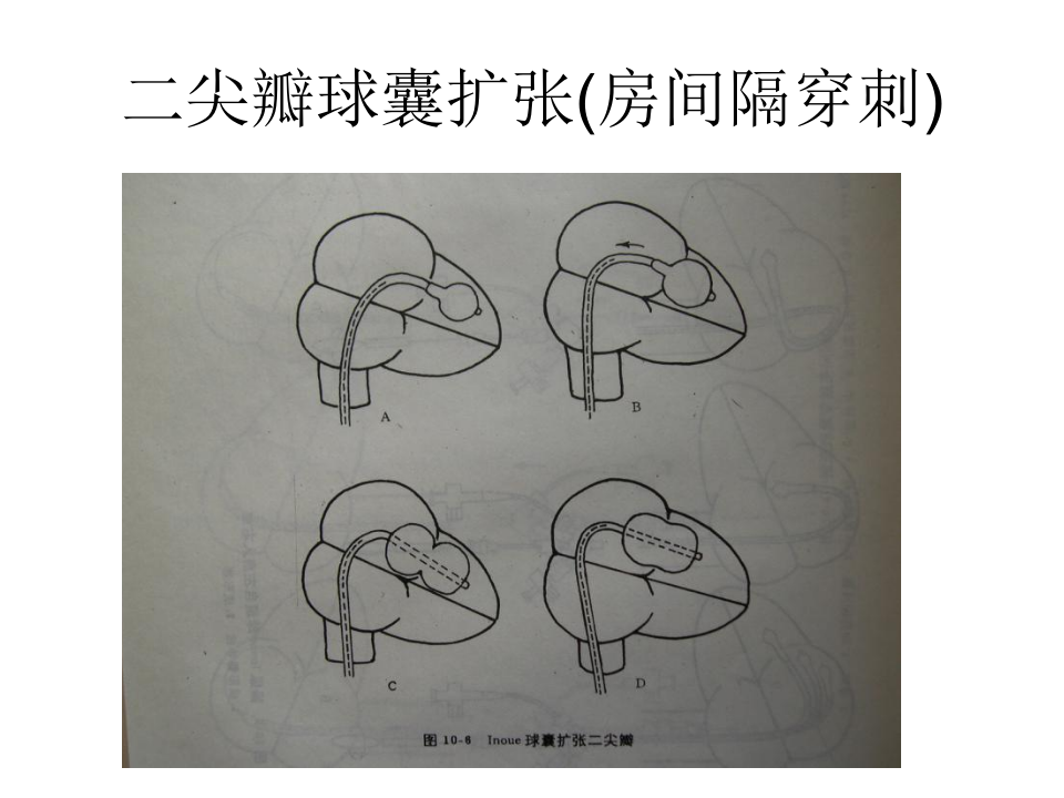 04-05介入性心脏病学.ppt 第3页