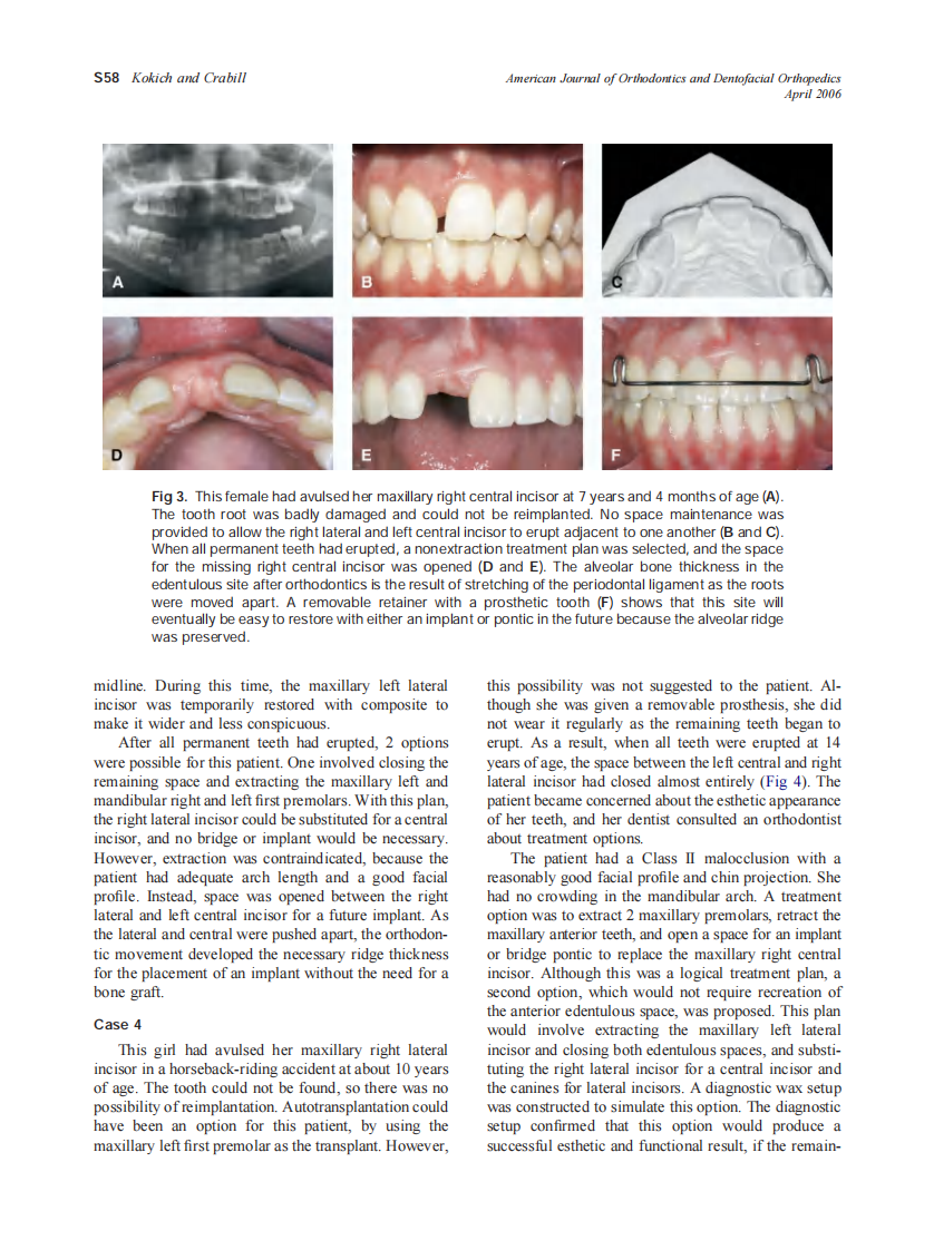 2006_129_4-Suppl-1_S55_S63_Kokich.pdf 第4页