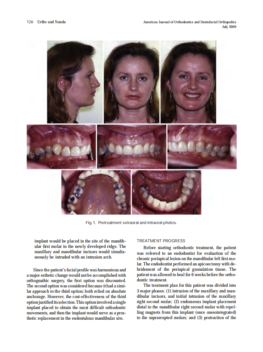 Uribe_Intramaxillary-and-intermaxillary-absolute-anchorage-with-an-endosseous-dental-implant-and-rare-earth-magnets_2009.pdf 第3页