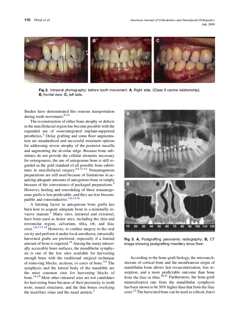 Vitral_Orthodontic-distalization-with-rigid-plate-fixation-for-anchorage-after-bone-grafting-and-maxillary-sinus-lifting_2009.pdf 第2页