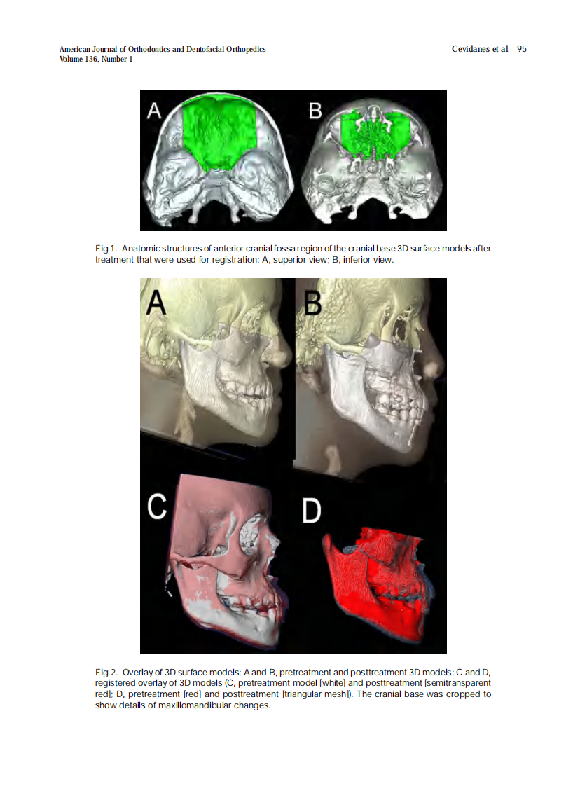 Cevidanes_Superimposition-of-3-dimensional-cone-beam-computed-tomography-models-of-growing-patients_2009.pdf 第2页