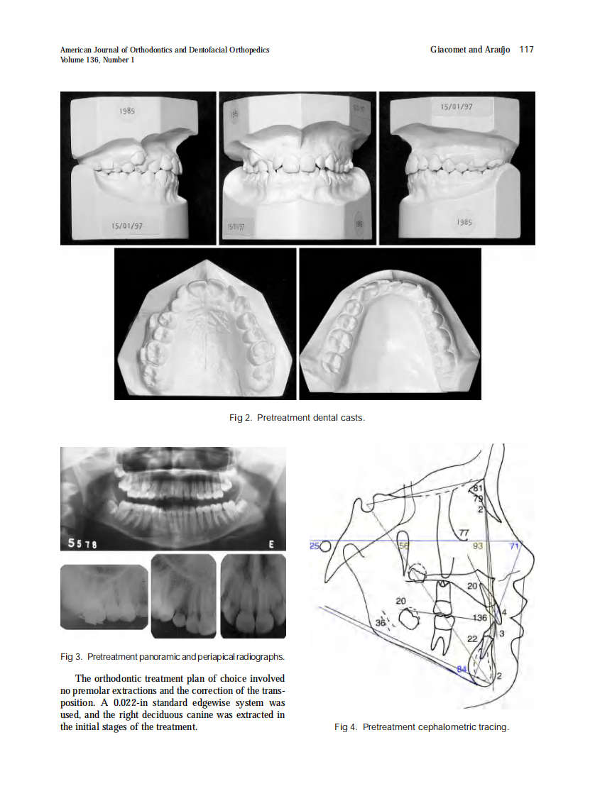 Giacomet_Orthodontic-correction-of-a-maxillary-canine-first-premolar-transposition_2009.pdf 第3页